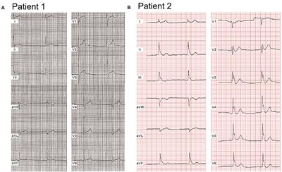 Clinical and Functional Genetic Characterization of the Role of Cardiac Calcium Channel Variants in the Early Repolarization Syndrome